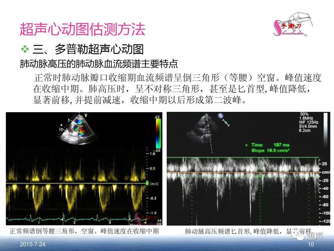 肺动脉高压的超声评估方法