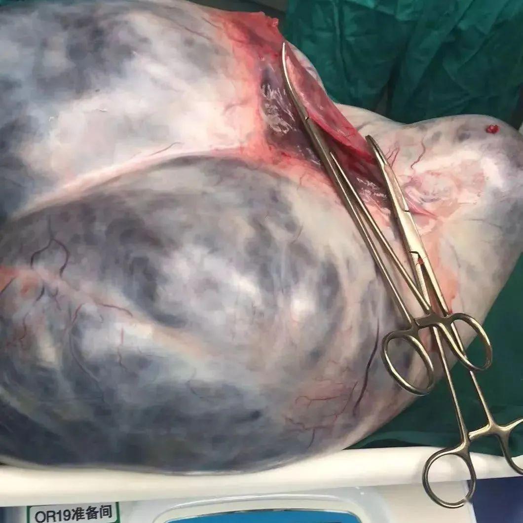 26岁女子肚大如箩医生掏出20斤肿瘤警惕沉默杀手