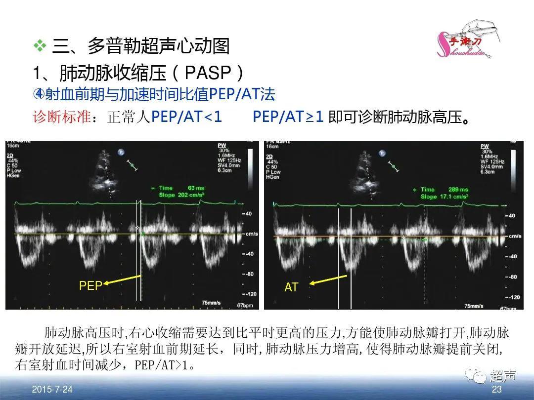 肺动脉高压的超声评估方法