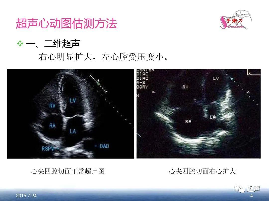 肺动脉高压的超声评估方法