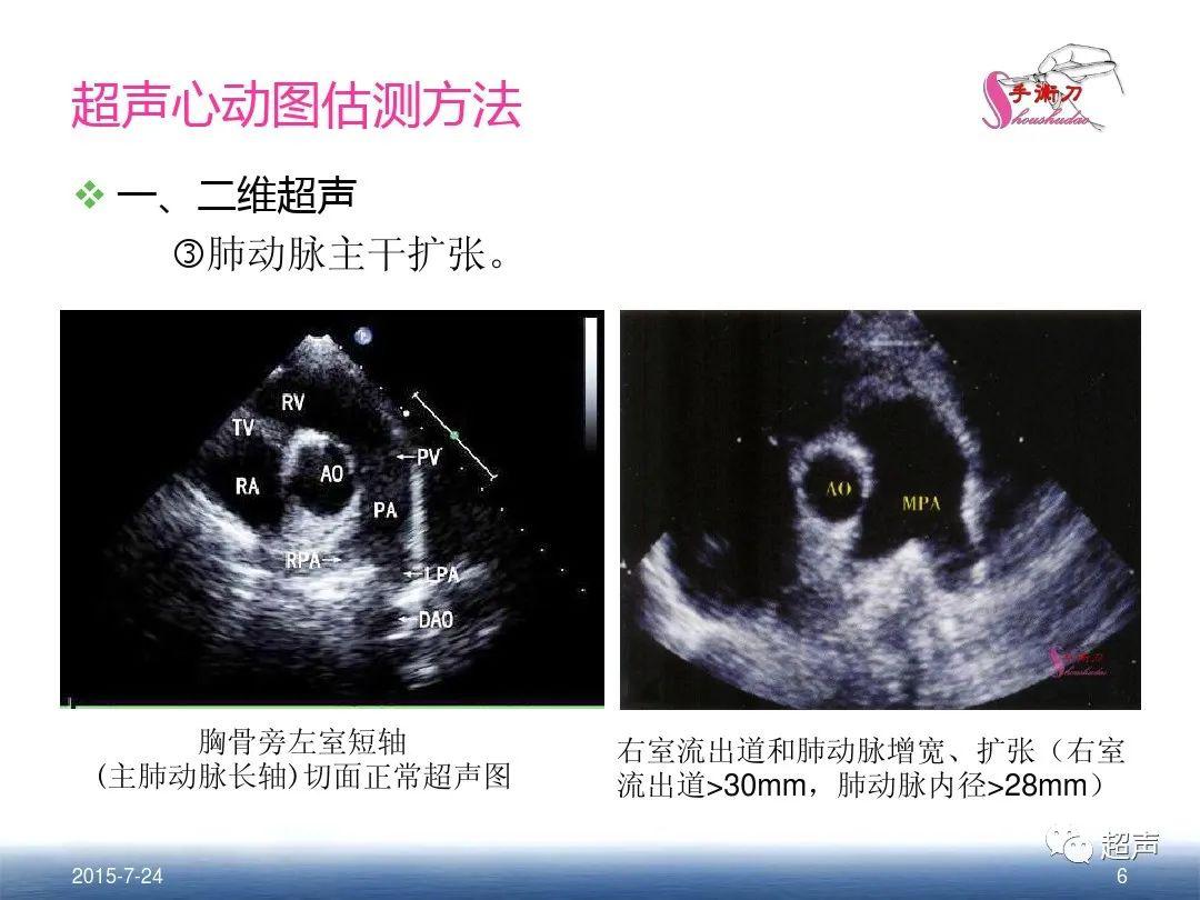 肺动脉交叉超声图片图片