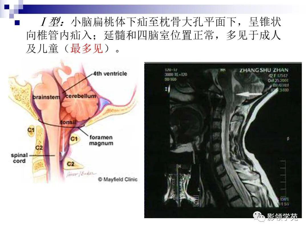 小脑扁桃体疝图片