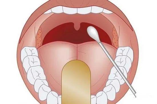 扁桃體發炎這4種症狀較常見快對號入座吧
