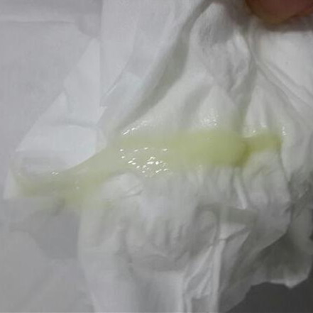白带有异臭味是什么病图片