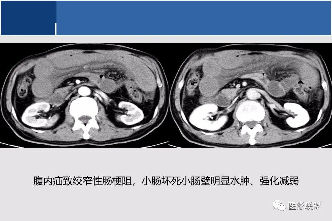 小肠ctmr影像诊断及进展