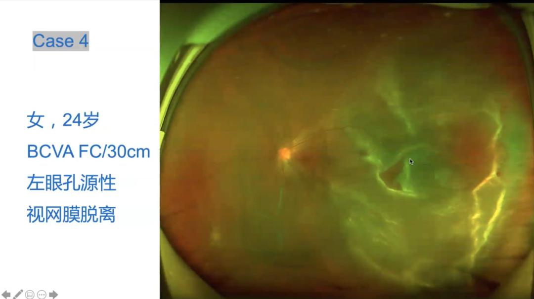 欧堡精品课张静琳院长你不知道你错过了什么视网膜脱离就只是视网膜