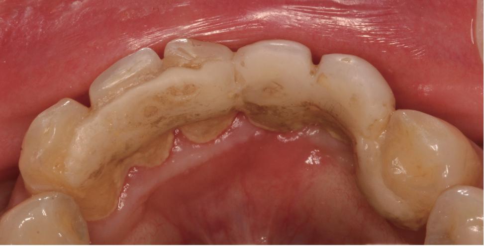 图10 玻璃纤维增强树脂粘接桥的连接体断裂图11 玻璃纤维增强树脂粘接