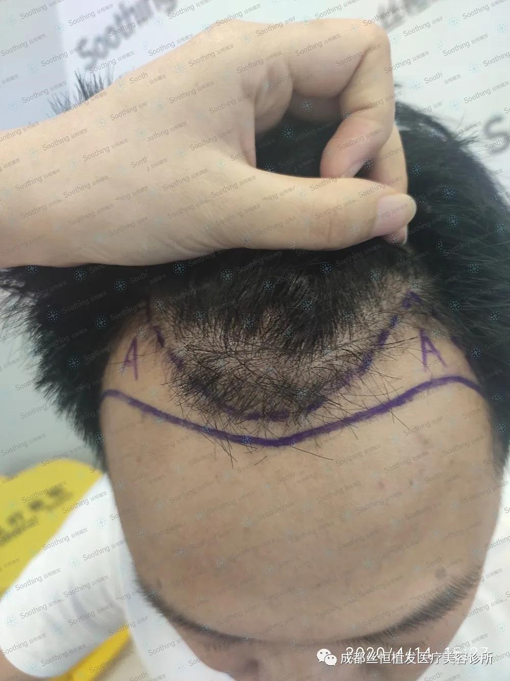 然后护士给我剪个"囚头",换了专门的衣服,就往手术台上面趴着了,开始