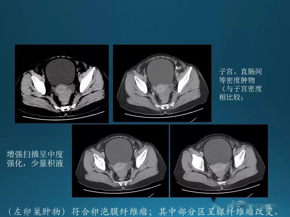 有视频:卵泡膜纤维瘤的诊断及鉴别诊断