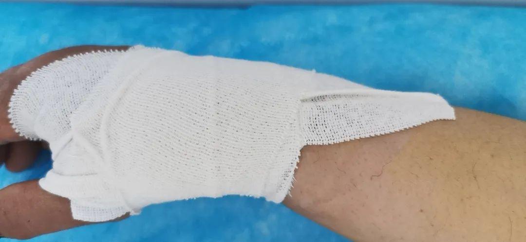 常规桡动脉穿刺熟练的术者再釆用该方法;第三,术后一定要正确压迫包扎