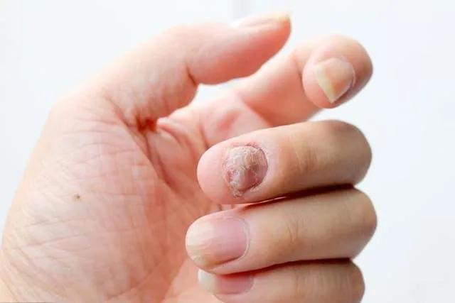 大蒜,陈醋,在中医的手里,就能变成改善灰指甲的法宝!
