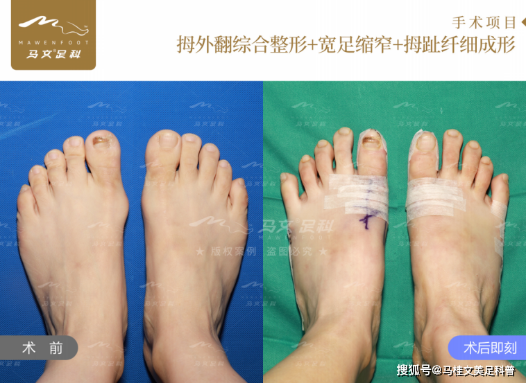 问题|马桂文：拇外翻哪家医院好？真人经历分享
