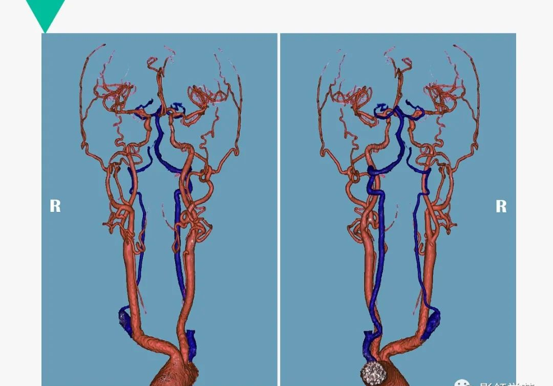 头颅血管成像图解图片