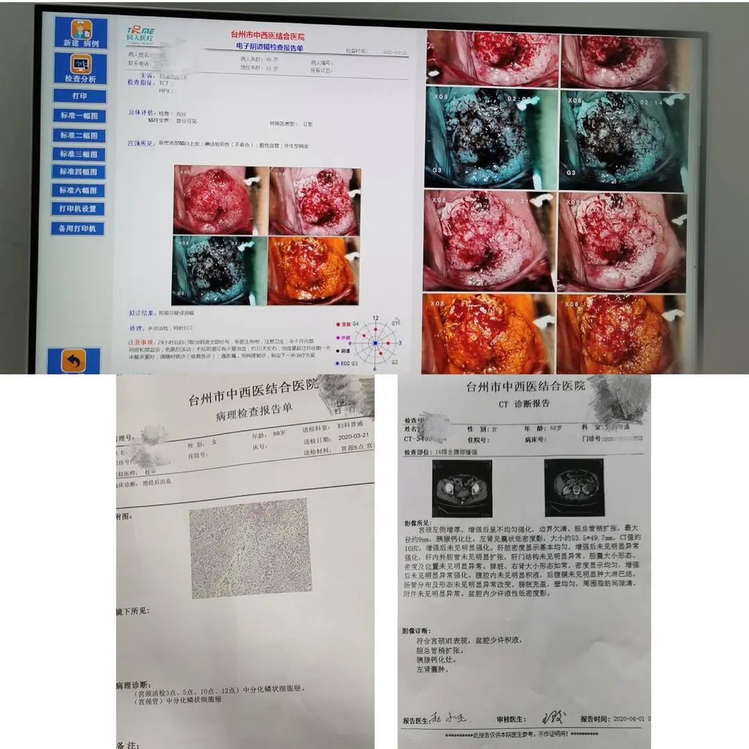 子宫内膜癌出血图片图片