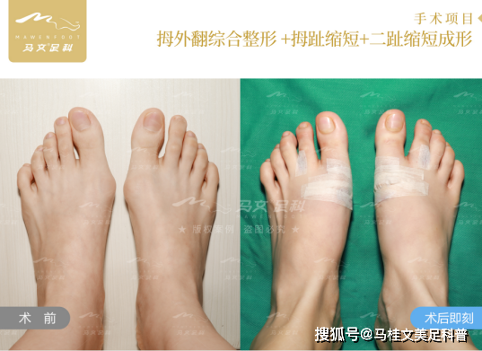 问题|马桂文：拇外翻哪家医院好？真人经历分享