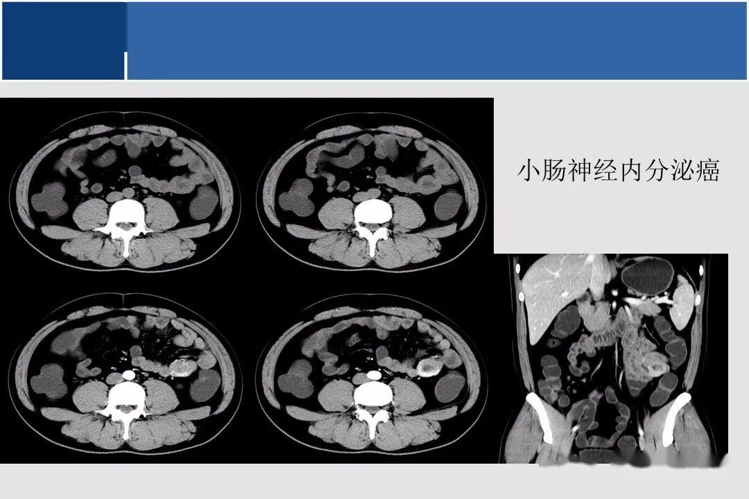 小肠ctmr影像诊断及进展