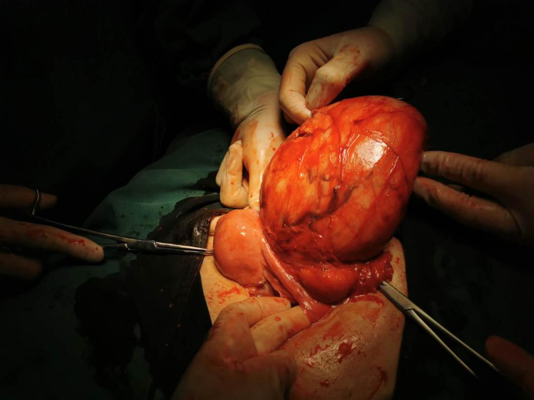 精准诊断 精湛医术—新郑市第二人民医院妇产科巨大肿块切除纪实_子宫