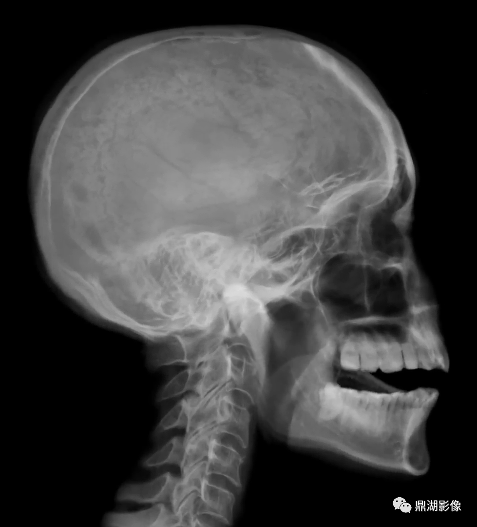 呈边缘不规则但比较锐利的低密度区,常对称位于额顶骨矢状窦两旁,居中