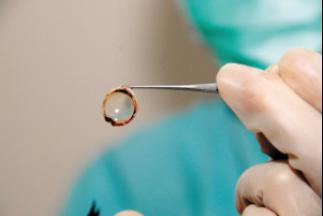 【角膜捐献】80岁老人欲捐眼角膜,永留光明在人间