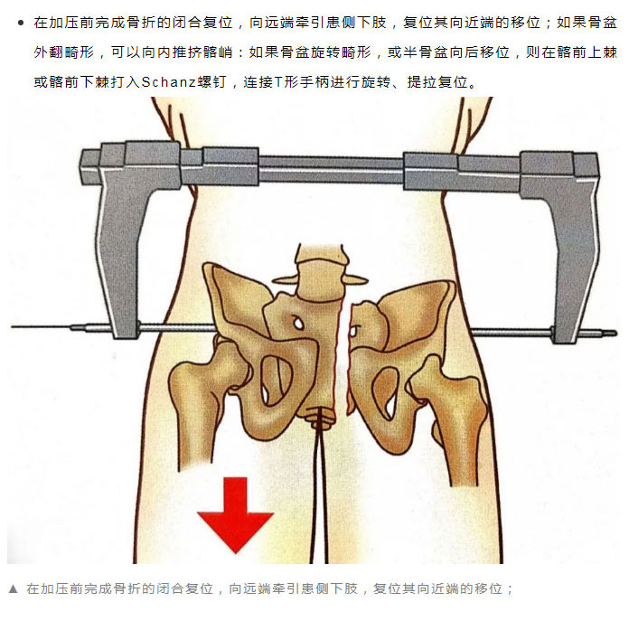 骨盆外固定架进针点图片
