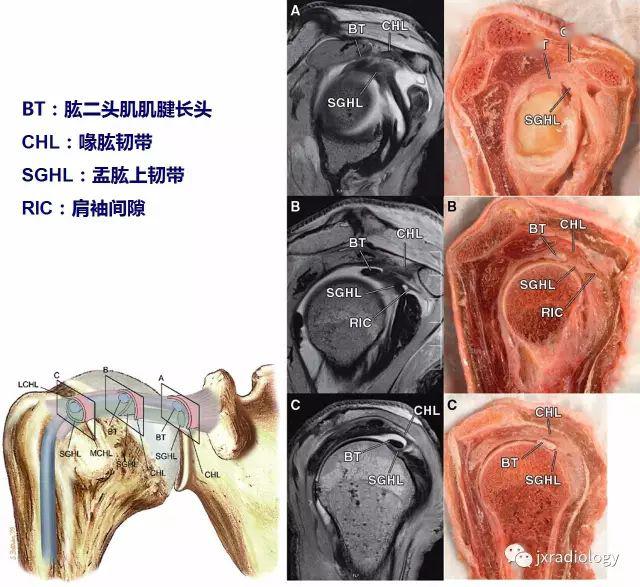 肩袖间隙的解剖及常见病变