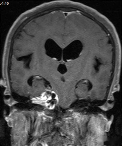 case 2:34 岁,女性,左侧桥小脑角区听神经鞘瘤脑膜瘤颅内脑外最常见的