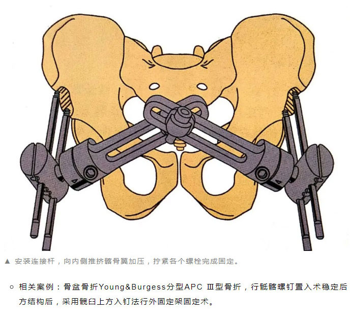 骨学堂骨盆骨折的外固定和急救技术讲解