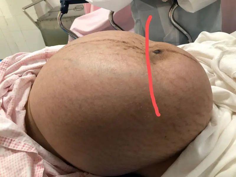 深圳丨心真大少女未婚生子未产检进产房才知腹内的这个东西比宝宝还大