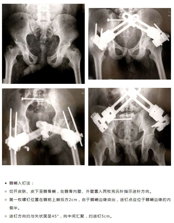 骨盆外固定架进针点图片