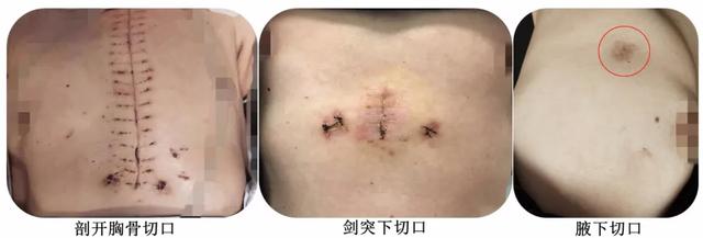 硕士生导师,总院长叶惠龙的带领下,成功开展大量胸部疾病微创手术,如