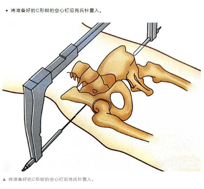 骨學堂骨盆骨折的外固定和急救技術講解