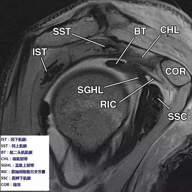 肩袖间隙的解剖及常见病变