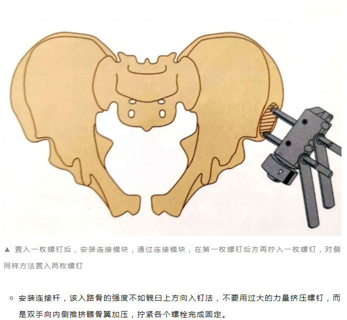 骨学堂骨盆骨折的外固定和急救技术讲解