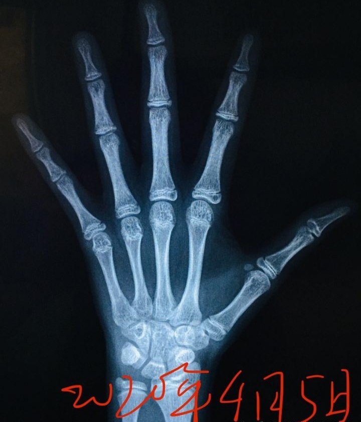 原创骨龄鉴定标准不同,数据差距有多少?