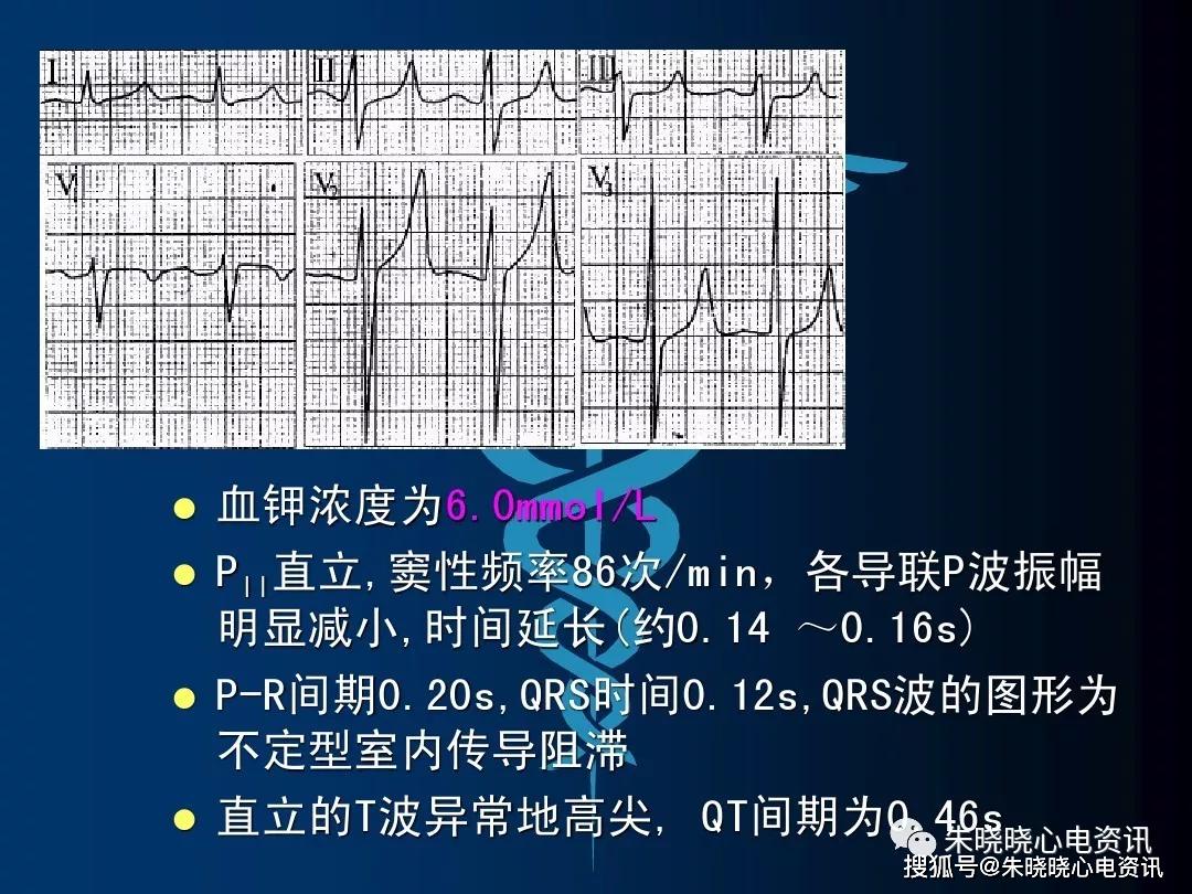血钾与心电图