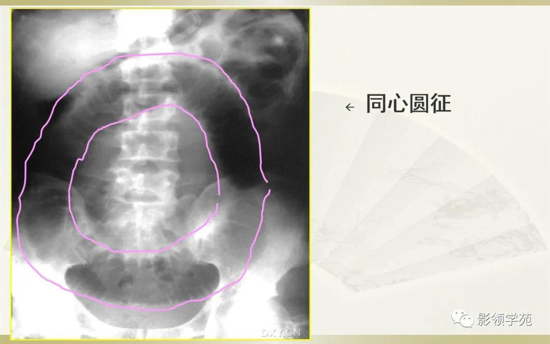 小肠气液平图片