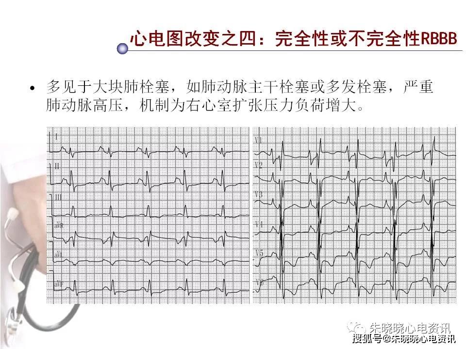 肺栓塞的心电图表现图片