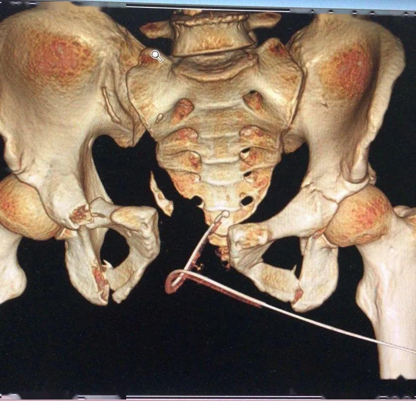 北京积水潭医院完成国内首例急诊导航下开放骨盆骨折手术成功挽救患者