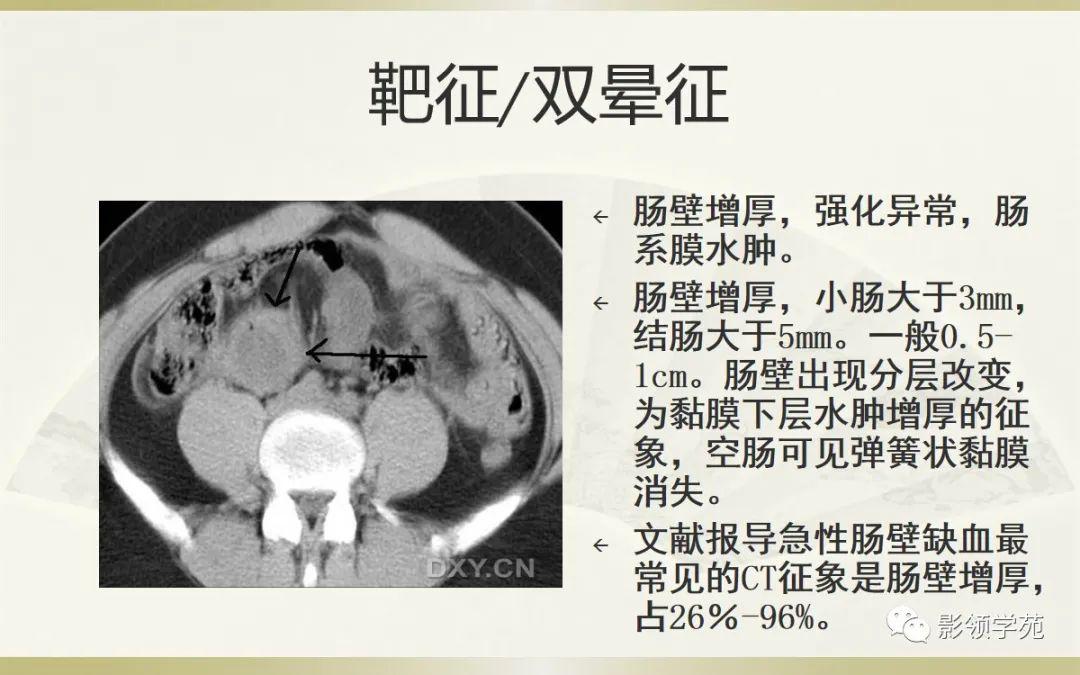 空肠梗阻图片