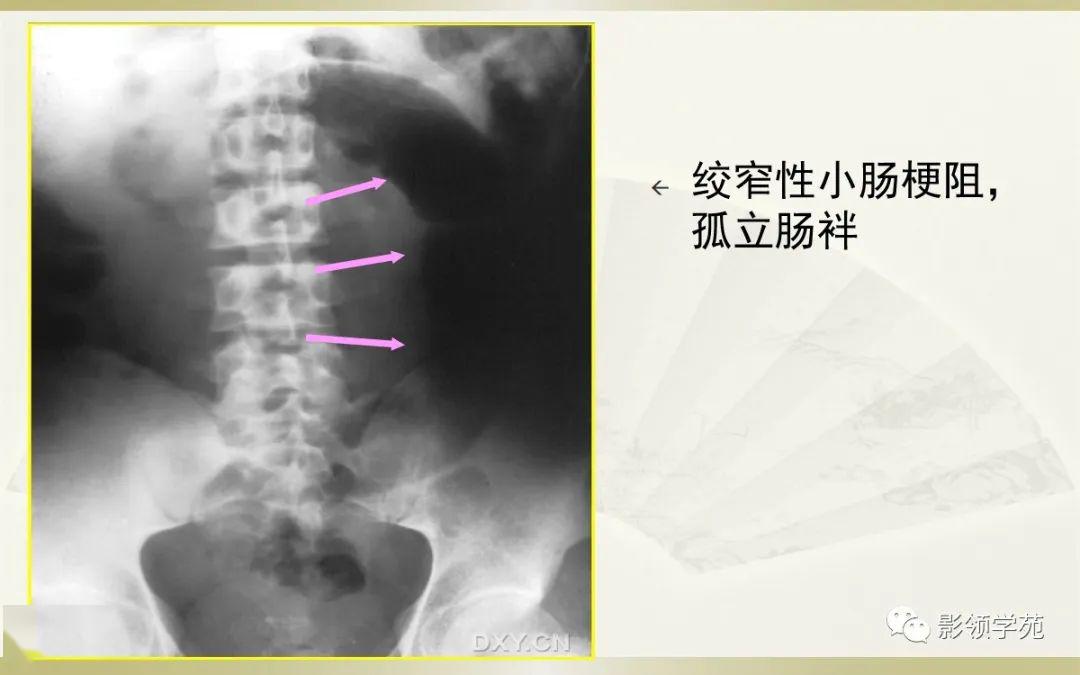 孤立肠袢图片