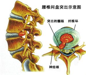 腰椎间盘突出示意图