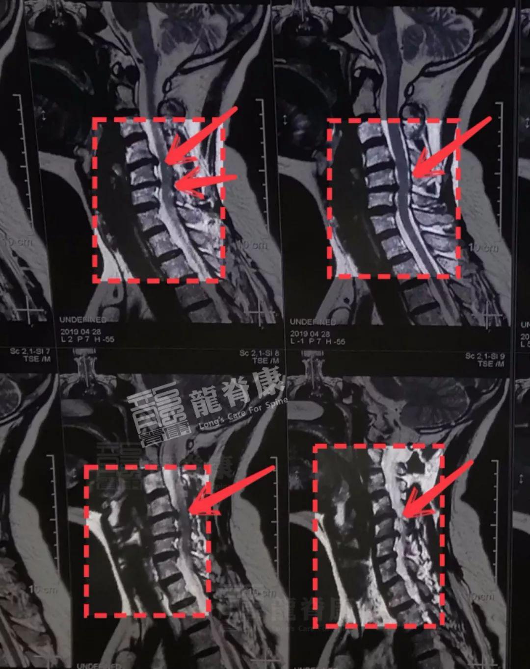 病例颈椎间盘突出找到病根有多重要这位患者被成功堵在手术台前