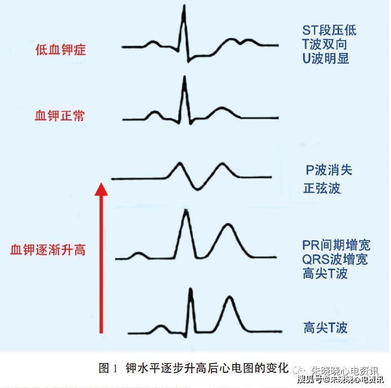 高血钾心电图表现图形图片