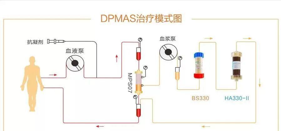 dpmas治疗示意图双重血浆分子吸附系统(double plasma molecular