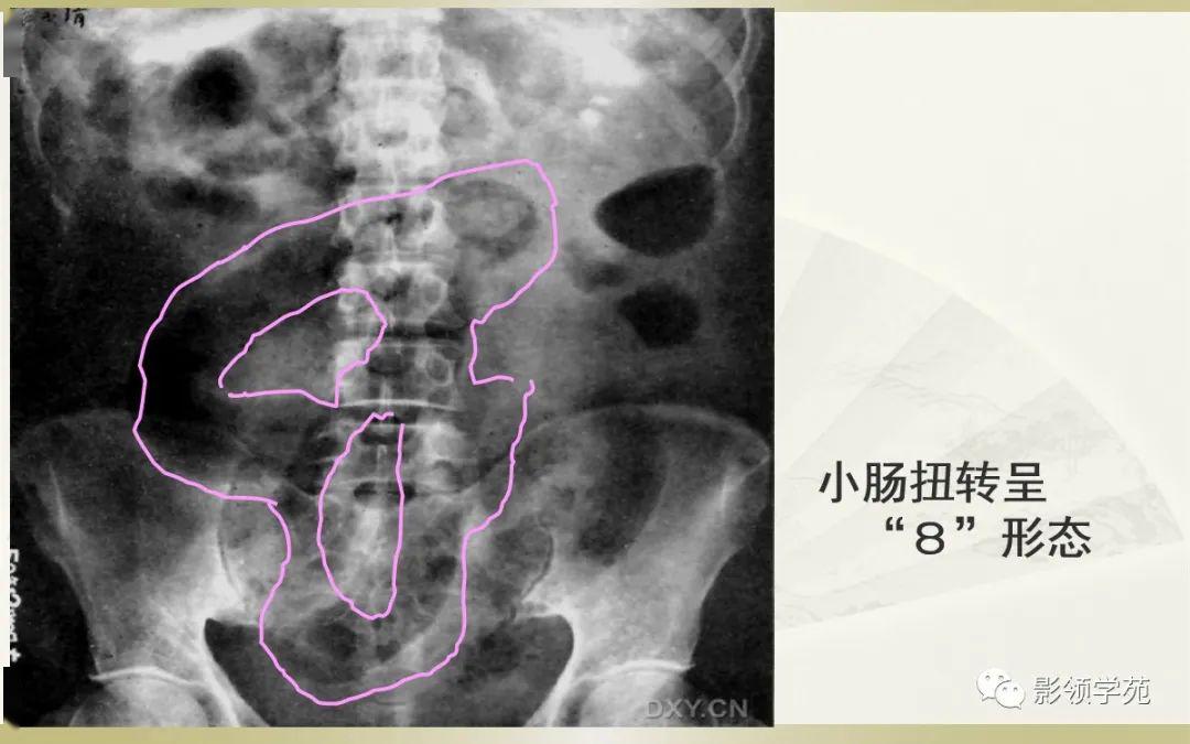 小孩肠梗阻x线图片图片