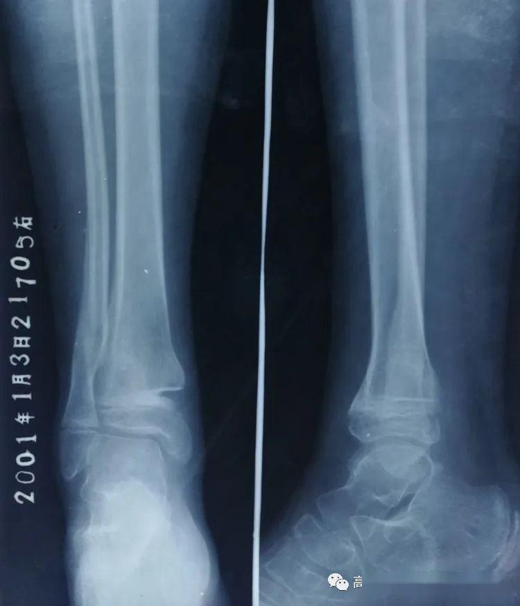 武氏正骨武氏正骨疗法选登14