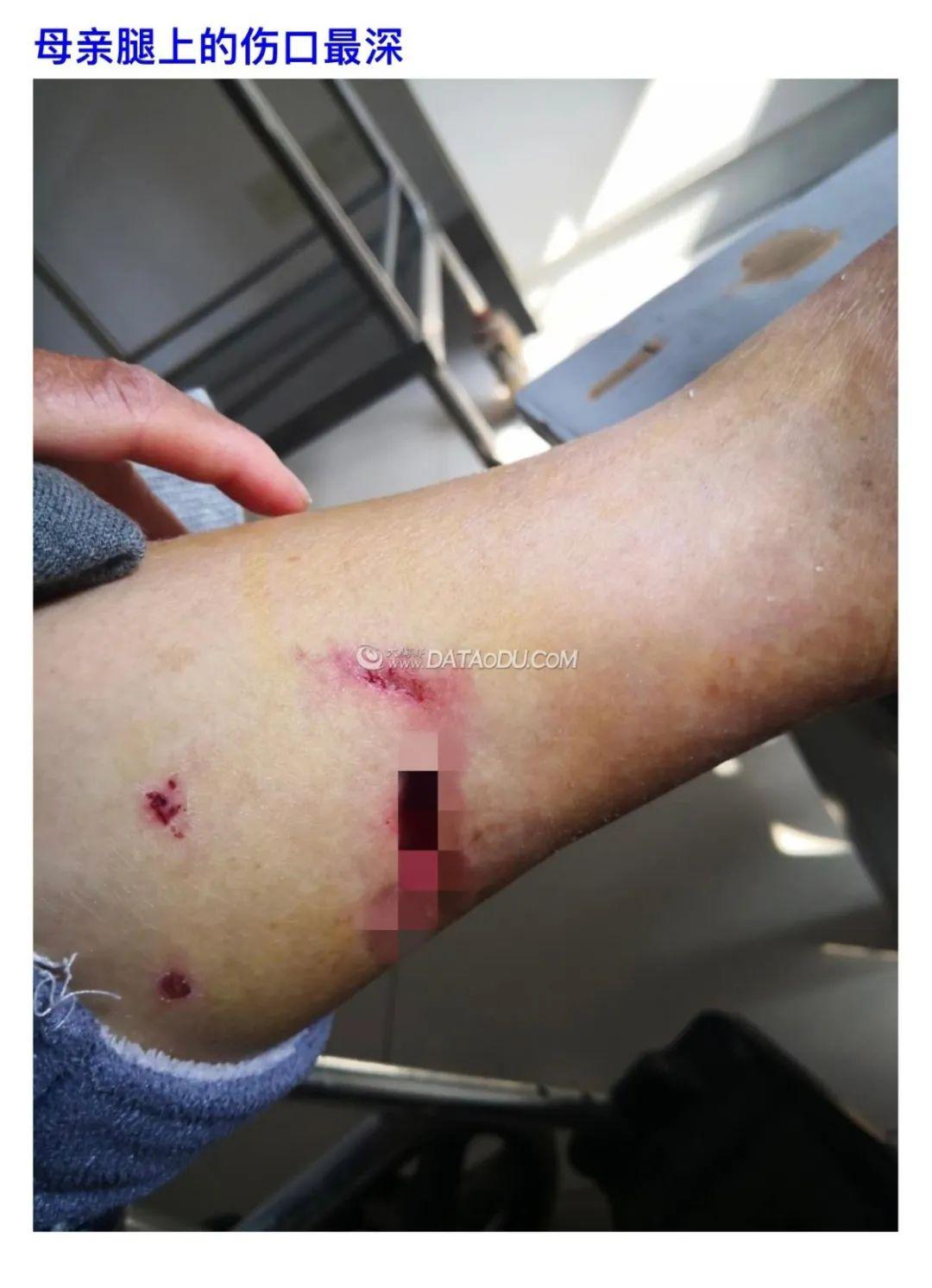 遛狗牵绳不脱档丨宜兴烈性犬咬人致三级咬伤不文明养犬何时休