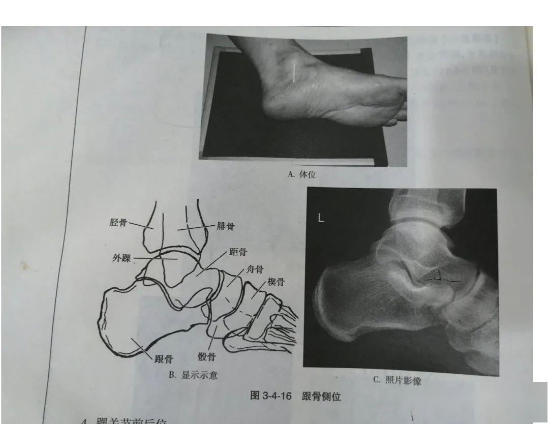 跟骨解剖细节图谱 x线图片