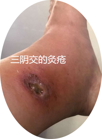 灸疮一发祛病如抓发生灸疮排病的效果更好