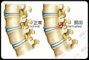 腰椎间盘突出做微创